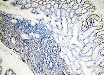 Image: Photomicrograph showing cells proliferating in an intestinal tumor (Photo courtesy of Sanford-Burnham Medical Research Institute).